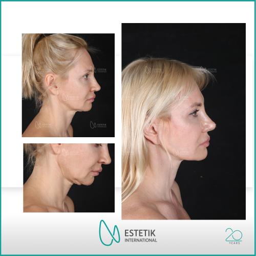 Before after photos of our patients 10